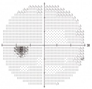 Visual Field Normal